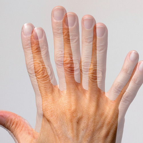 diplopia , ceratocone