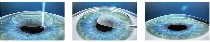 smile, cirurgia refrativa