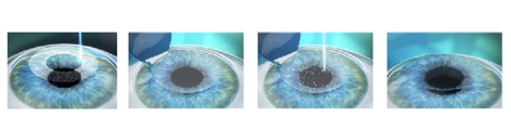 lasik , cirurgia refrativa