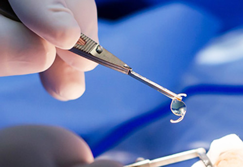 lente introcular , catarata