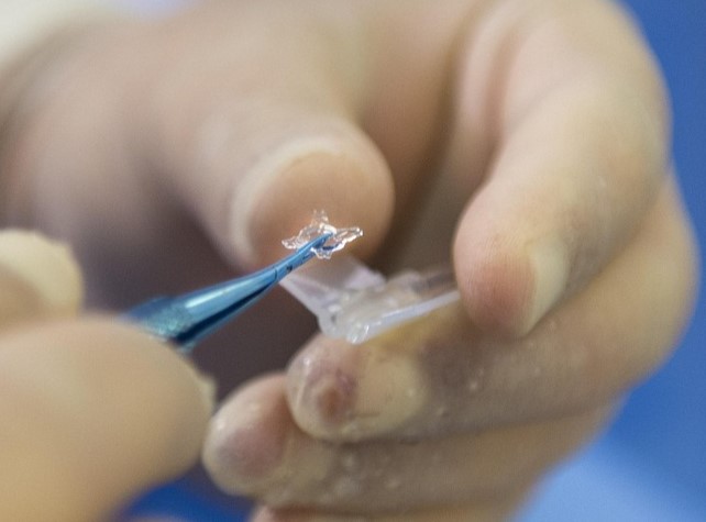 lente intraocular , cirurgia refrativa