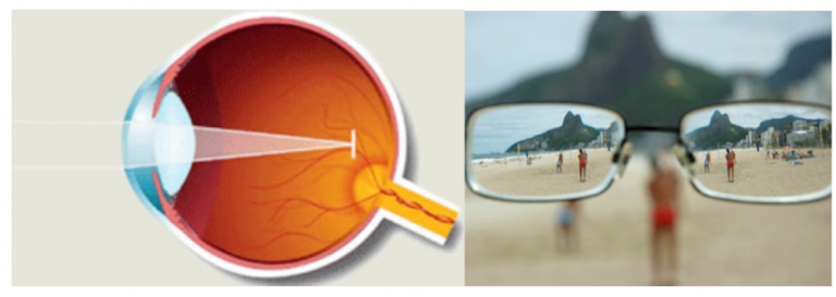 miopia , cirurgia refrativa