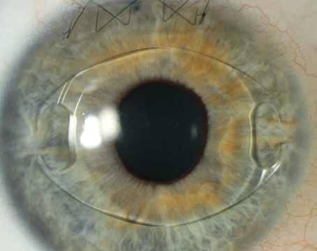 lente intraocular, cirurgia refrativa