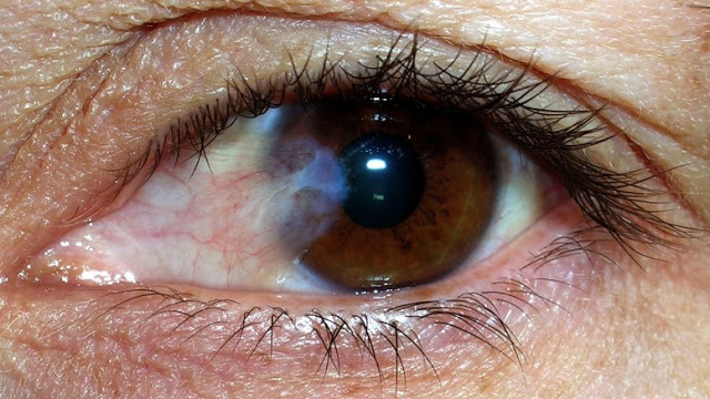 pterígio , catarata